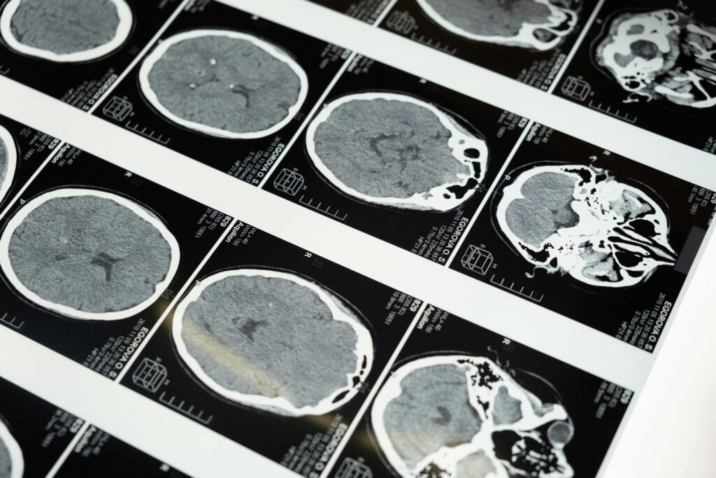 pexels-photo-5723883-5723883 Detailed brain MRI scans displayed on a lightbox, showcasing medical imaging techniques.