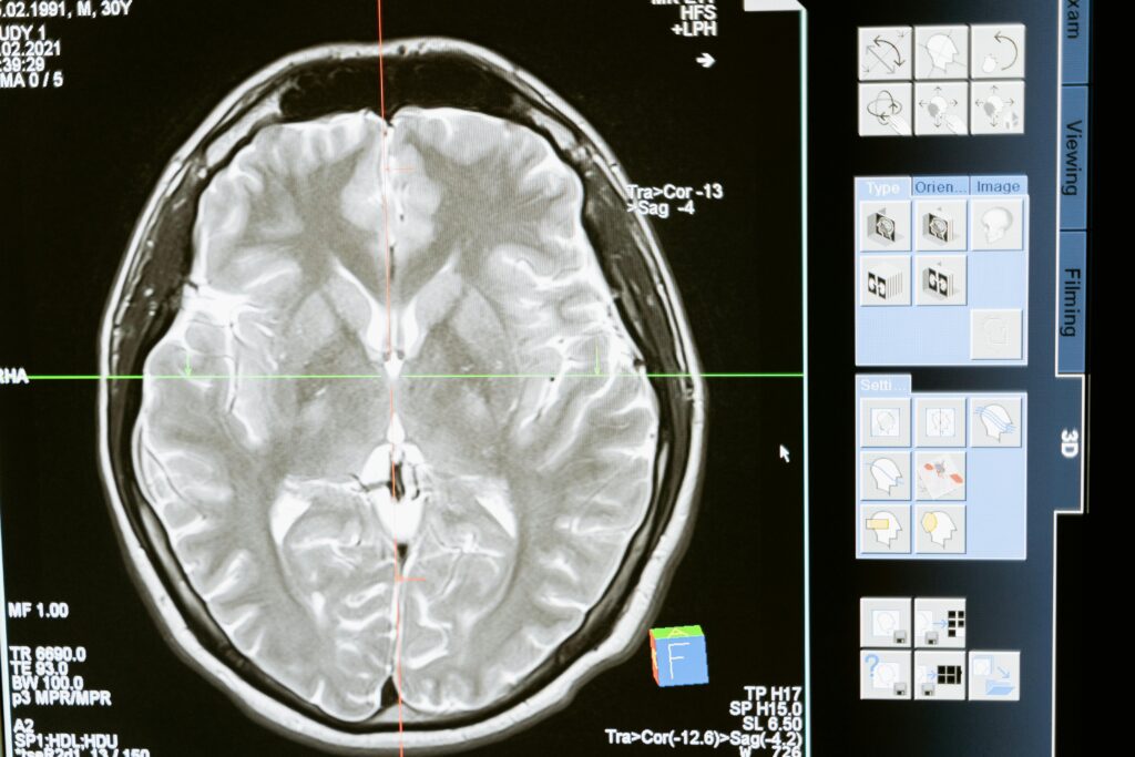 pexels-photo-7089020-7089020 Intricate MRI brain scan displayed on a computer screen for medical analysis and diagnosis.